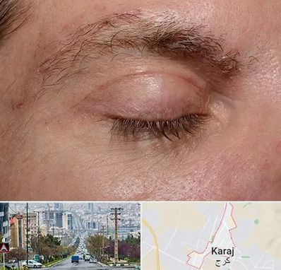 جراح بلفاروپلاستی در گوهردشت کرج 