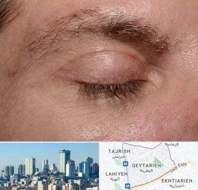 جراح بلفاروپلاستی در قیطریه 