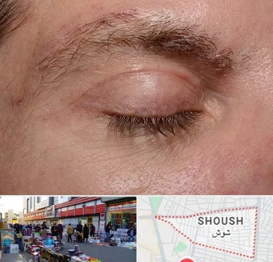 جراح بلفاروپلاستی در شوش