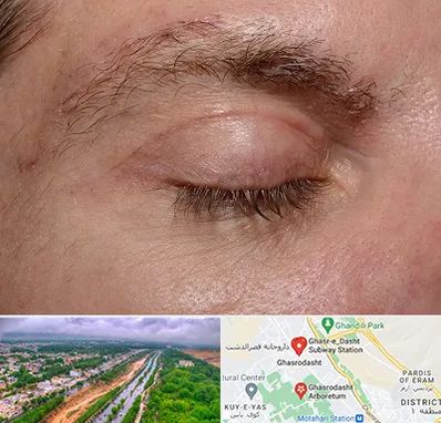 جراح بلفاروپلاستی در قصرالدشت شیراز