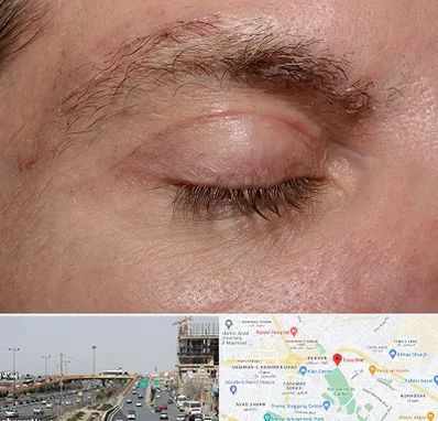 جراح بلفاروپلاستی در بلوار توس مشهد 