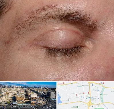 جراح بلفاروپلاستی در شهرک راه آهن