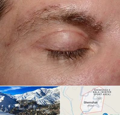 جراح بلفاروپلاستی در شمشک