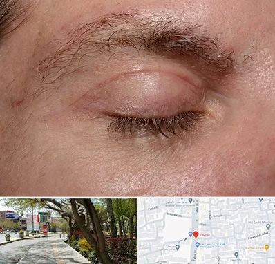 جراح بلفاروپلاستی در خیابان توحید اصفهان