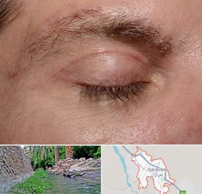 جراح بلفاروپلاستی در سراوان