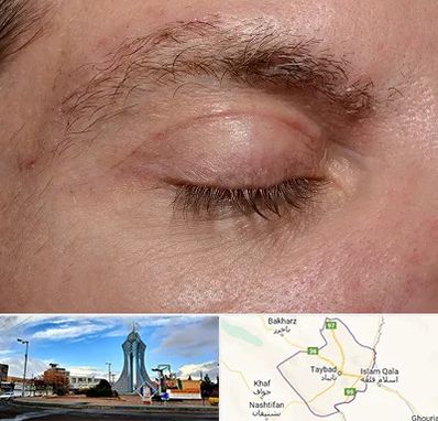 جراح بلفاروپلاستی در تایباد