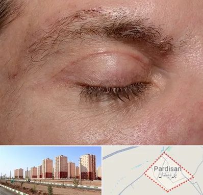 جراح بلفاروپلاستی در پردیسان قم
