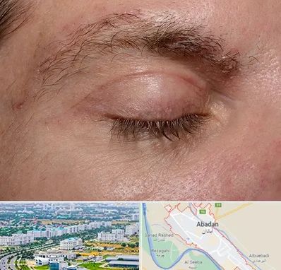 جراح بلفاروپلاستی در آبادان