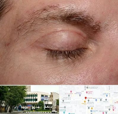 جراح بلفاروپلاستی در طالقانی 