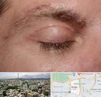 جراح بلفاروپلاستی در گیشا 