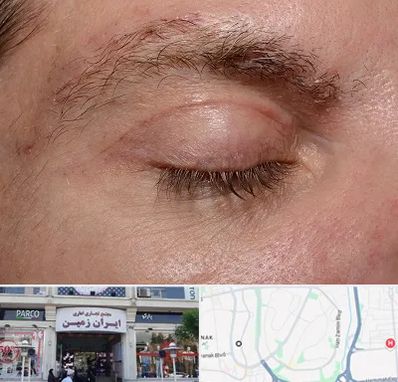 جراح بلفاروپلاستی در ایران زمین