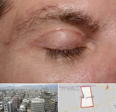 جراح بلفاروپلاستی در شمس آباد تهران