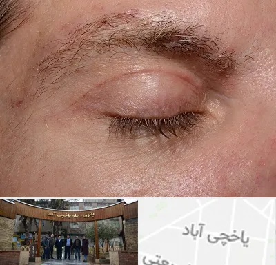جراح بلفاروپلاستی در یاخچی آباد
