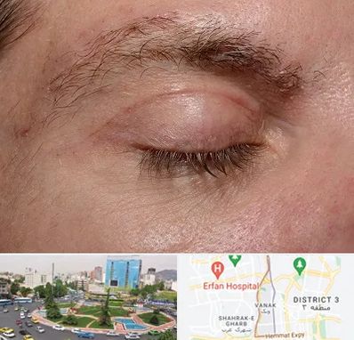 جراح بلفاروپلاستی در ونک 