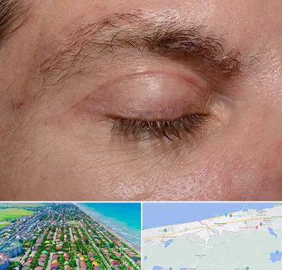 جراح بلفاروپلاستی در فریدونکنار