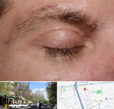 جراح بلفاروپلاستی در کوی فیروز تبریز