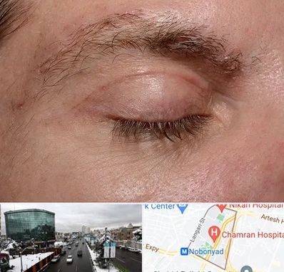 جراح بلفاروپلاستی در اقدسیه 