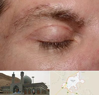 جراح بلفاروپلاستی در شهرضا