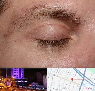 جراح بلفاروپلاستی در آبرسان تبریز