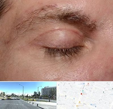جراح بلفاروپلاستی در بلوار کلاهدوز مشهد 