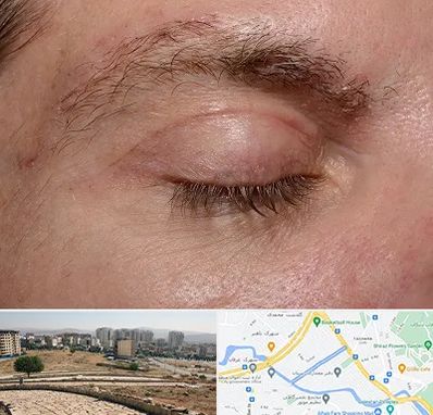 جراح بلفاروپلاستی در کوی وحدت شیراز