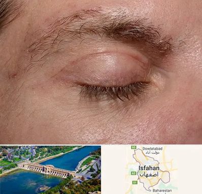 جراح بلفاروپلاستی در اصفهان