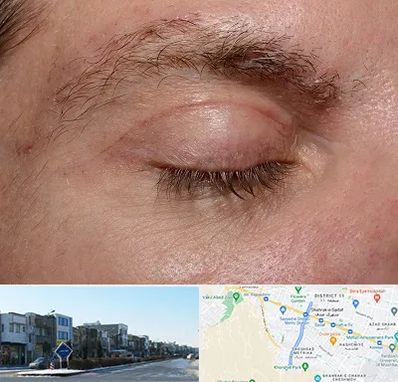 جراح بلفاروپلاستی در شریعتی مشهد