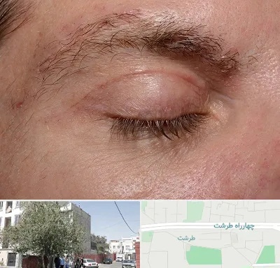 جراح بلفاروپلاستی در طرشت