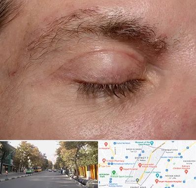 جراح بلفاروپلاستی در شریعتی 