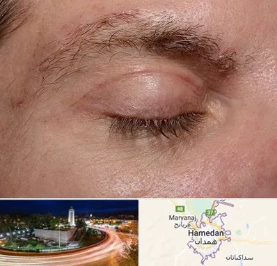 جراح بلفاروپلاستی در همدان