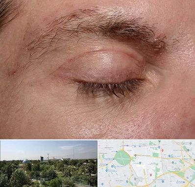 جراح بلفاروپلاستی در منطقه 16 تهران 