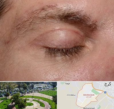 جراح بلفاروپلاستی در مهرشهر کرج 