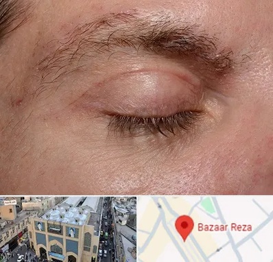 جراح بلفاروپلاستی در بازار رضا مشهد