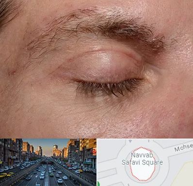 جراح بلفاروپلاستی در نواب