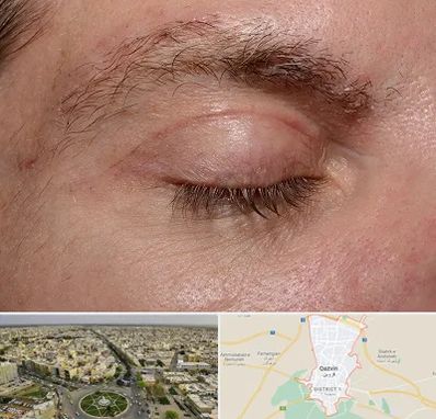 جراح بلفاروپلاستی در قزوین