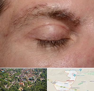 جراح بلفاروپلاستی در دماوند