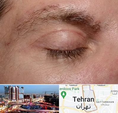 جراح بلفاروپلاستی در صادقیه 