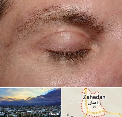 جراح بلفاروپلاستی در زاهدان