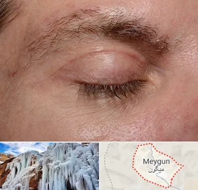 جراح بلفاروپلاستی در میگون