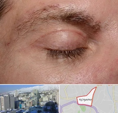 جراح بلفاروپلاستی در محمودیه