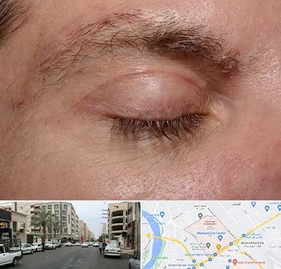 جراح بلفاروپلاستی در زیتون کارمندی اهواز