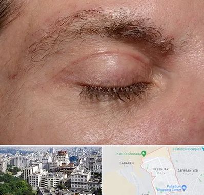 جراح بلفاروپلاستی در ولنجک 