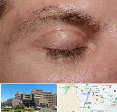 جراح بلفاروپلاستی در صیاد شیرازی مشهد