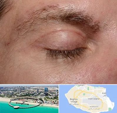 جراح بلفاروپلاستی در کیش