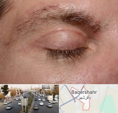 جراح بلفاروپلاستی در باقرشهر