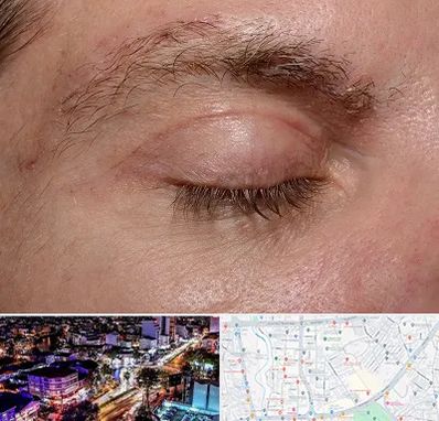 جراح بلفاروپلاستی در منظریه رشت