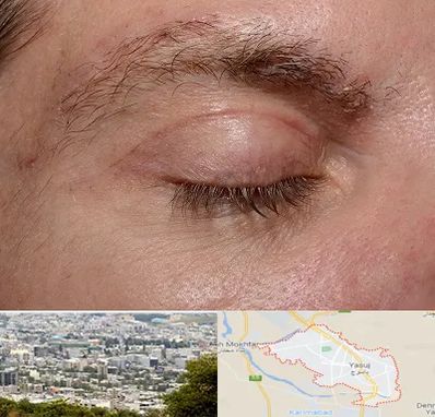 جراح بلفاروپلاستی در یاسوج