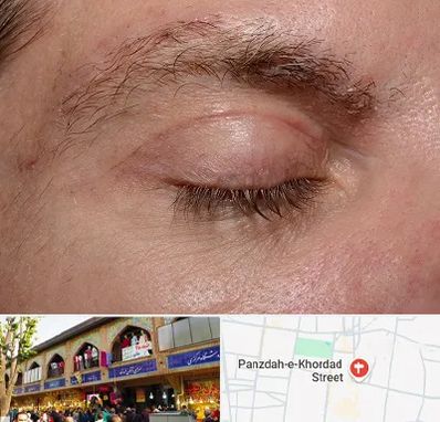 جراح بلفاروپلاستی در 15 خرداد