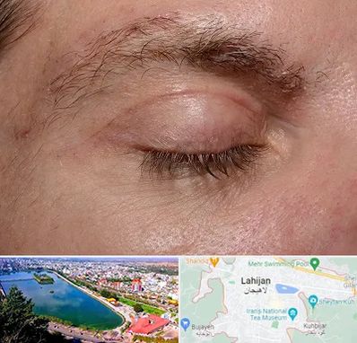 جراح بلفاروپلاستی در لاهیجان