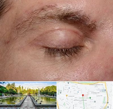 جراح بلفاروپلاستی در سرسبز 